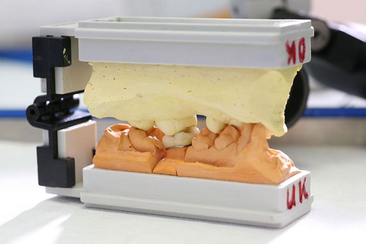 Zahnarzt Loerrach Zahnersatz Prothetik